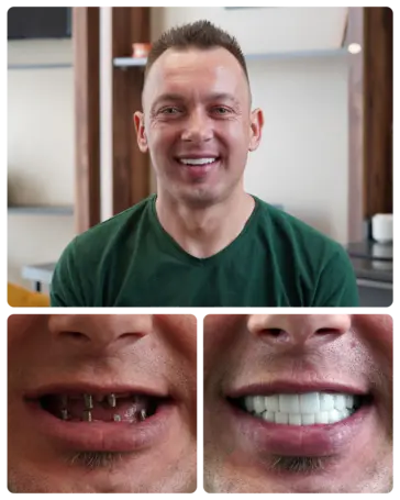 Full mouth Implants transformation — Mircea
